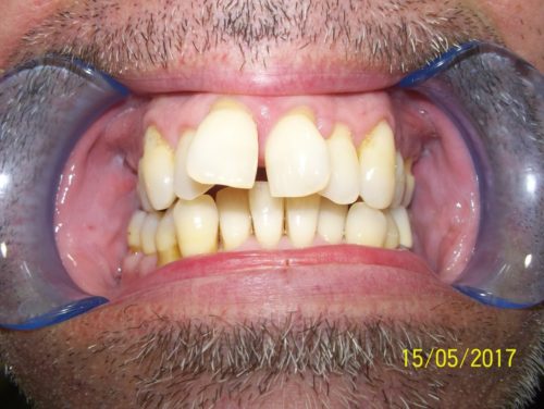 Mordida abierta anterior 2 ANTES