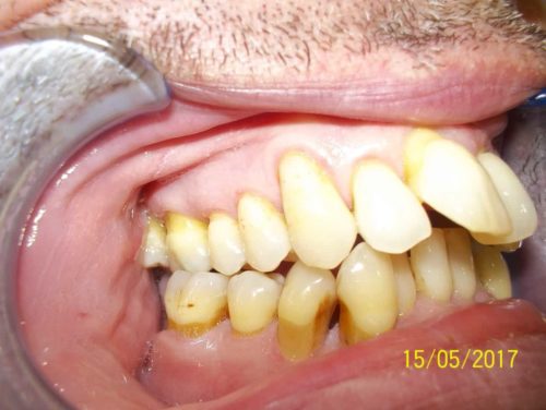 Mordida abierta anterior ii 500x376 1