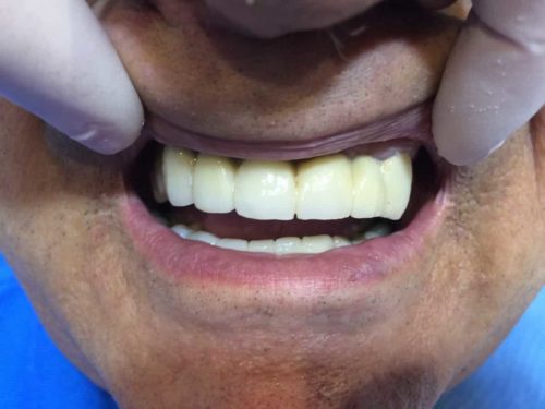 Rehabilitación con coronas de porcelana DESPUES 2