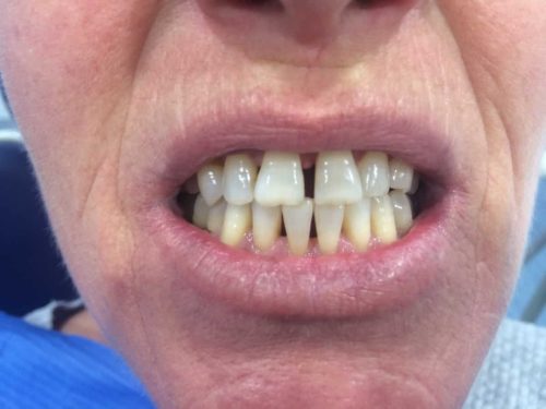 Rehabilitación con coronas de zirconio para cerrar espacios ANTES