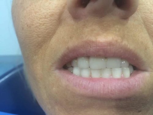 Rehabilitación con coronas de zirconio para cerrar espacios DESPUES