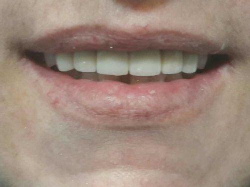 Rehabilitacion-con-fundas-de-porcelana-2-min-500x375