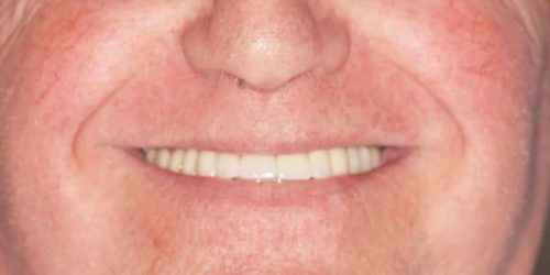 Rehabilitación con implantes y elevación de seno DESPUES 2