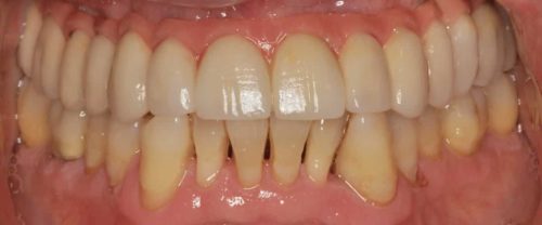 Rehabilitación con implantes y elevación de seno DESPUES