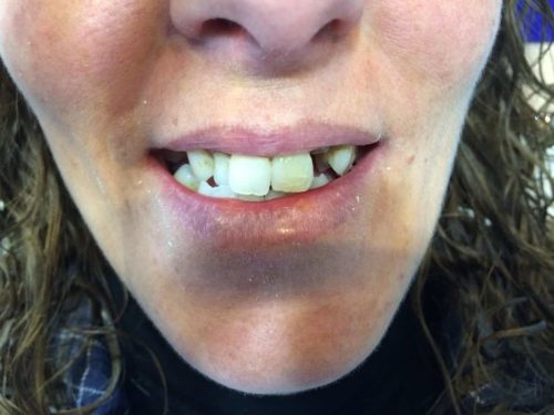 Rehabilitación con prótesis fija, para mejorar malposición dental y reponer ausencias ANTES