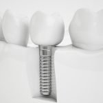 IMPLANTES DENTALES