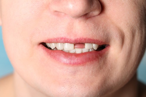 caida de dientes