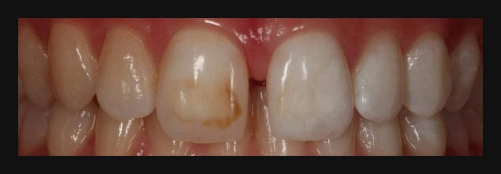 dientes amarillos