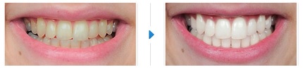 dientes amarillos soluciones