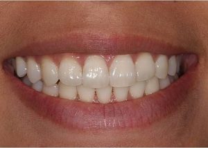 limpieza dental 