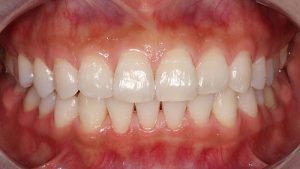 Qué es la limpieza dental: descripción general, beneficios y resultados esperados