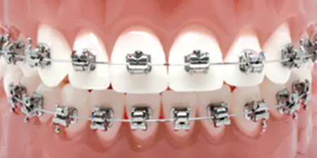 brackets metálicos