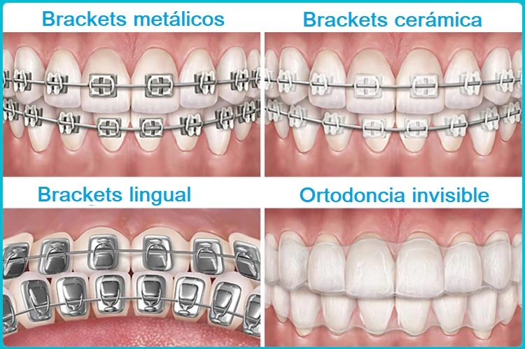 Brackets metalicos, ortodoncia, brackets ceramica Tipos de ortodoncia invisible — Grupo Gente Vital, clínica dental en Alcoy y Benetússer