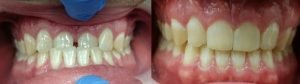 ortodoncia invisible antes y despues