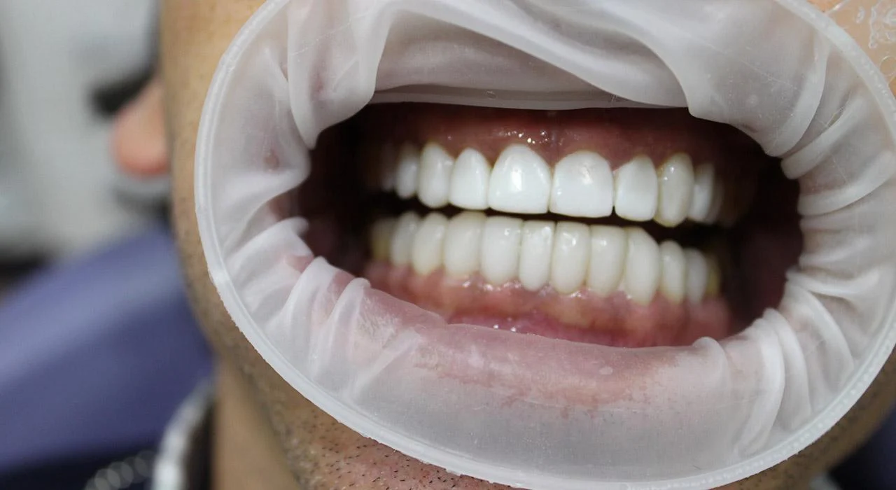 Adhesion compuesta dental 1