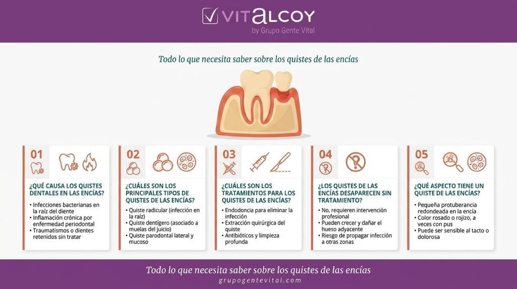 Tratamiento quiste en las encias Clínica dental Vitalcoy Tratamiento quiste en las encias Clínica dental Vitalcoy