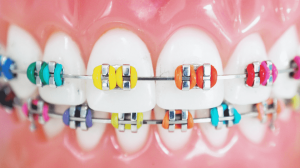 Color de brackets para que los dientes se vean blancos