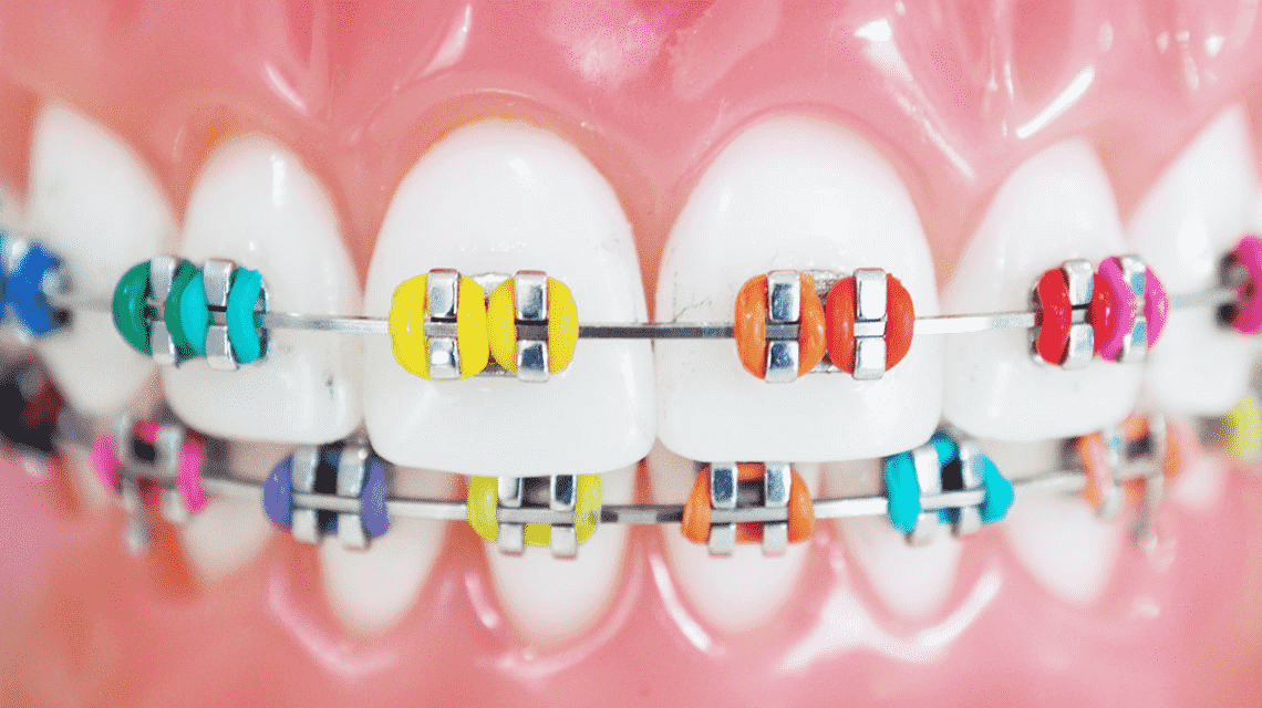 Color de brackets para que los dientes se vean blancos