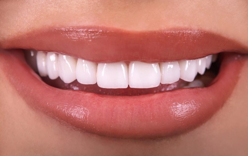 Beneficios de las carillas dentales. grupo gente vital