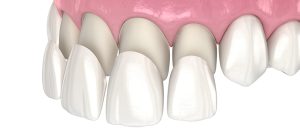 Descubre el Poder Transformador de las Carillas Dentales