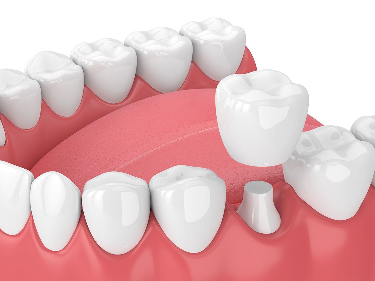 Todo lo que necesitas saber sobre las coronas de zirconio