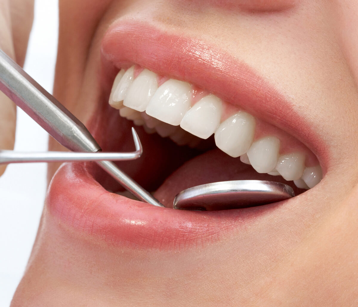 Cuidado de las carillas dentales Grupogentevital