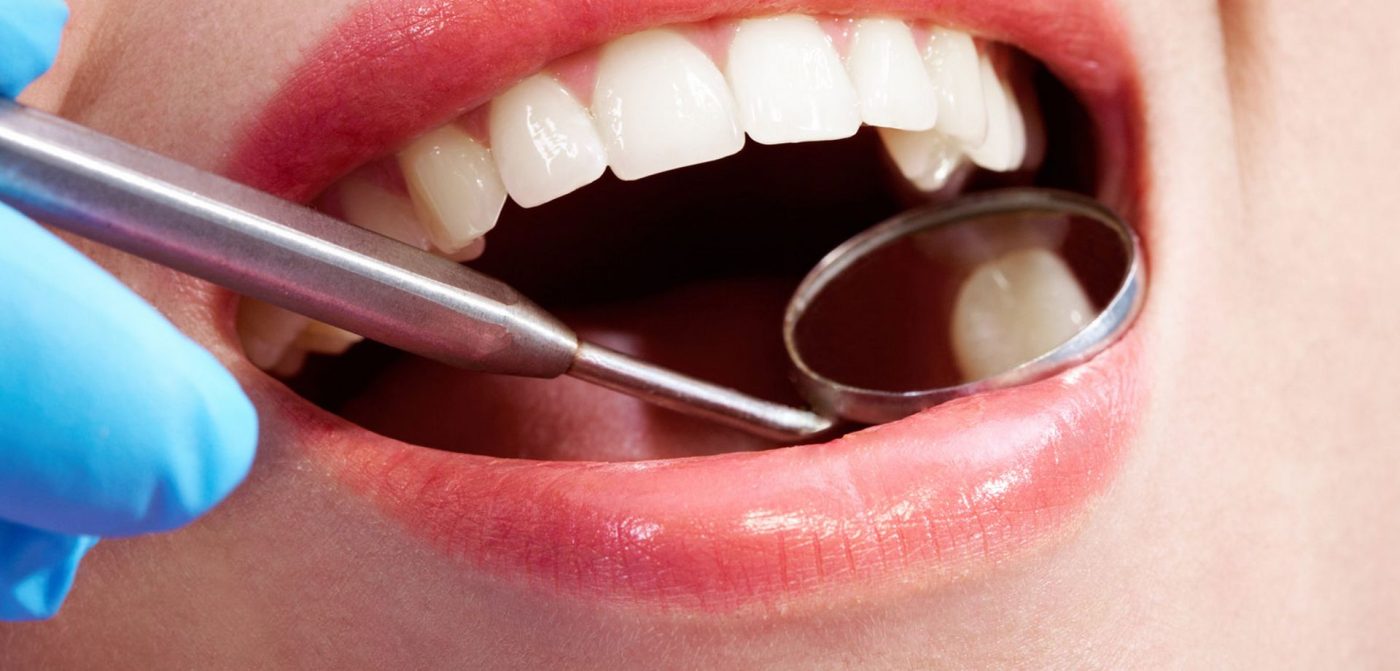 Ventajas y desventajas de las carillas dentales