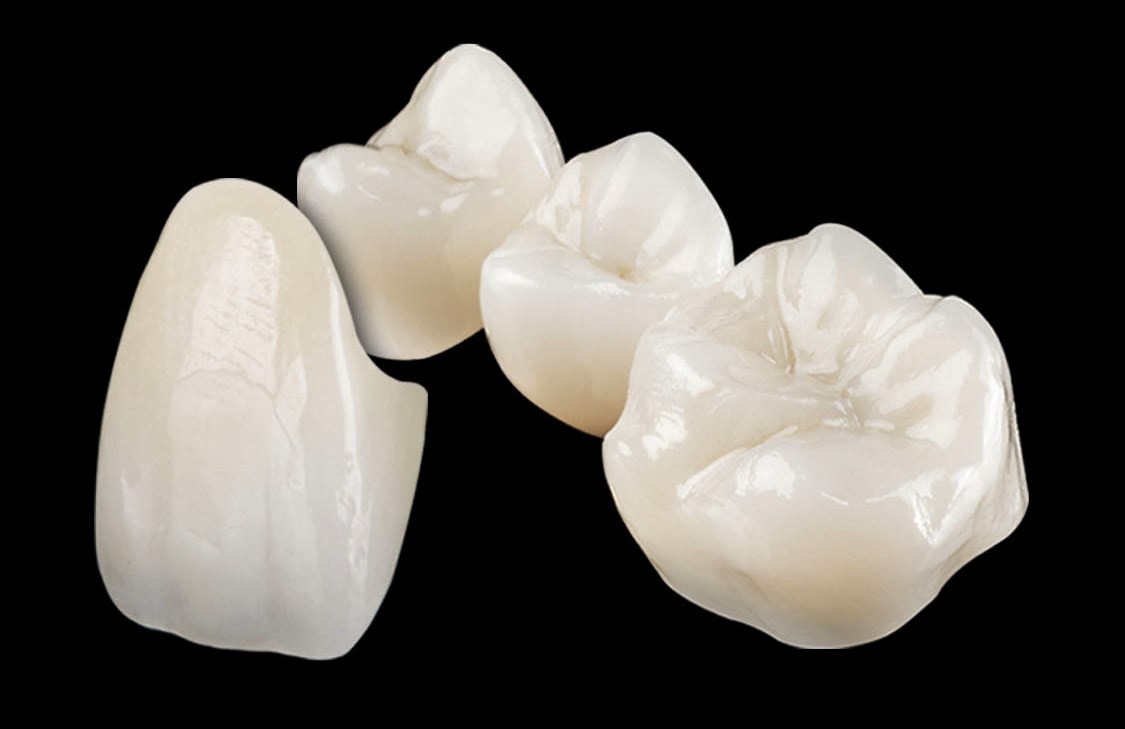 ¿Qué tipo de corona de zirconio es mejor?