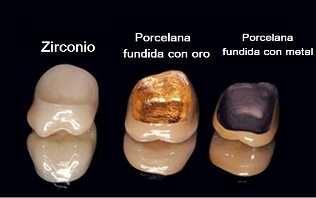 Diferentes tipos de coronas Coronas de zirconio