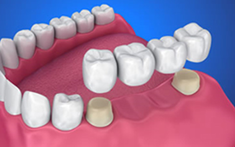 puente dental puente dental