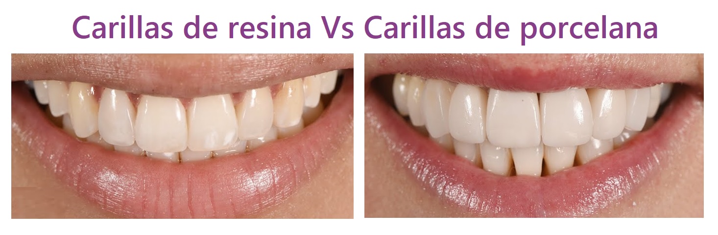 carillas de resina o carillas de porcelana