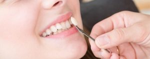 Precio de las carillas dentales: una guía completa para encontrar la mejor opción