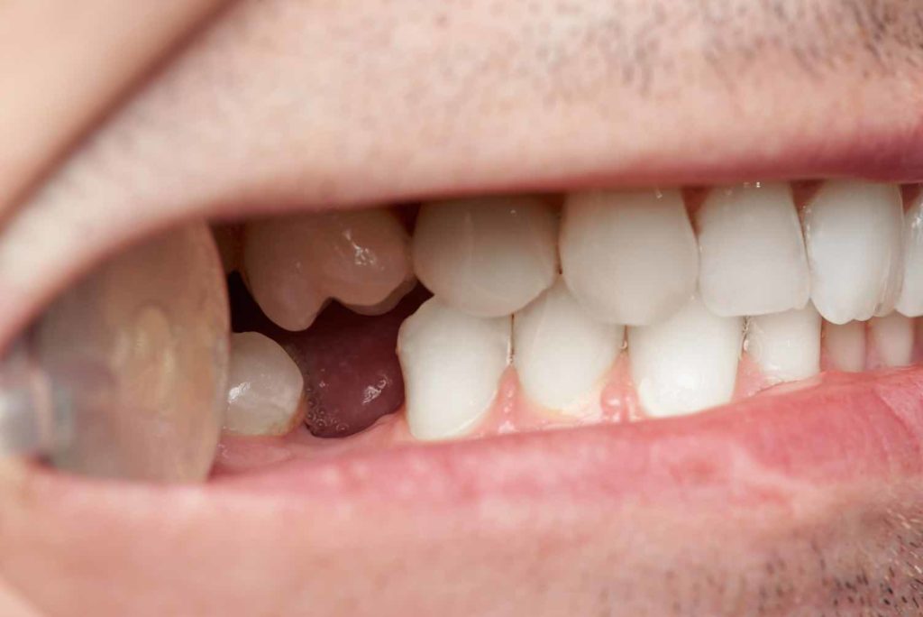 Perdida de dientes
