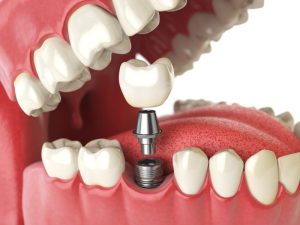 Implantes dentales de carga inmediata