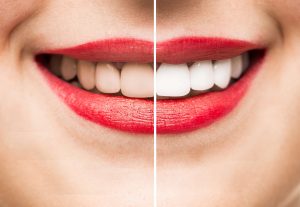 ¿Qué es el blanqueamiento dental con luz?