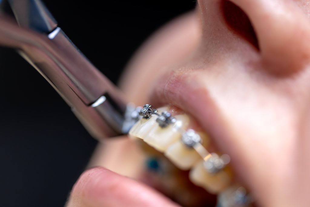 Colocacion de brackets, primer plano