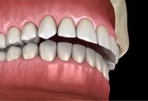 Sobremordida: Diferencias entre Invisalign y brackets