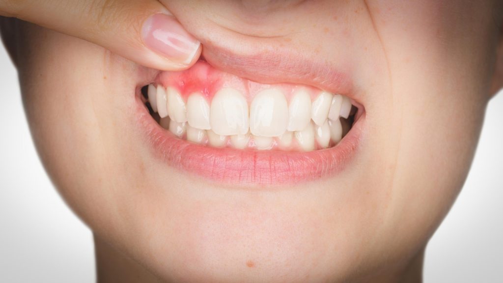 Enfermedades dentales comunes
