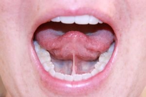 Frenillo Lingual Corto: Causas y tratamiento
