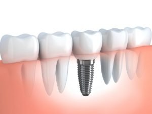Tipos de implantes dentales