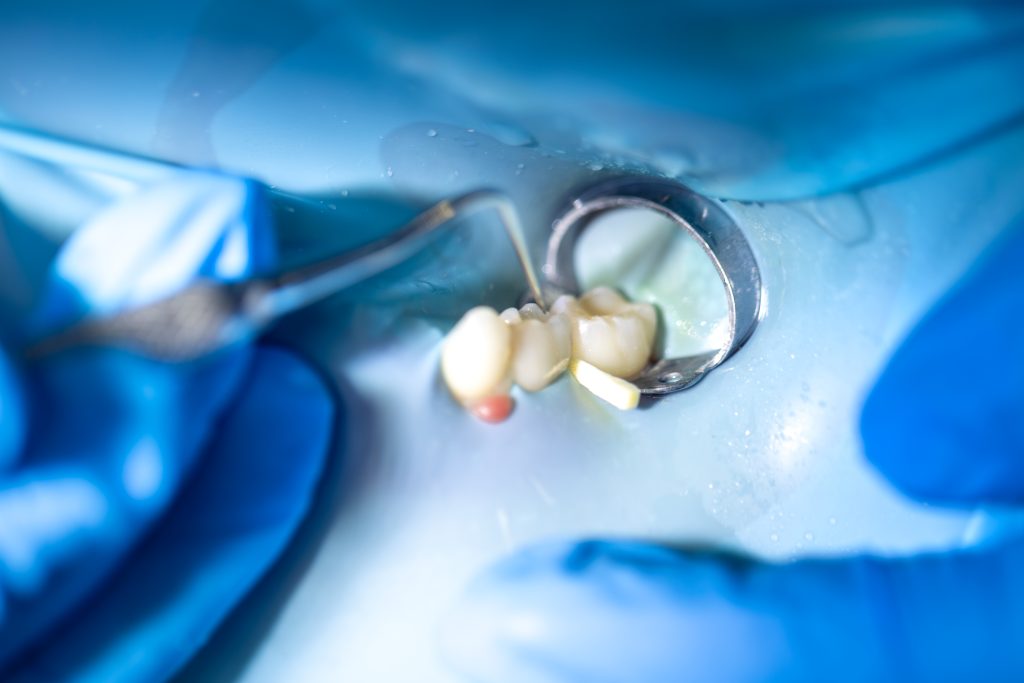 Tratamiento dental con aislamiento del campo