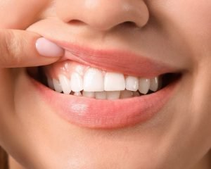 4 causas de los puntos negros en encías